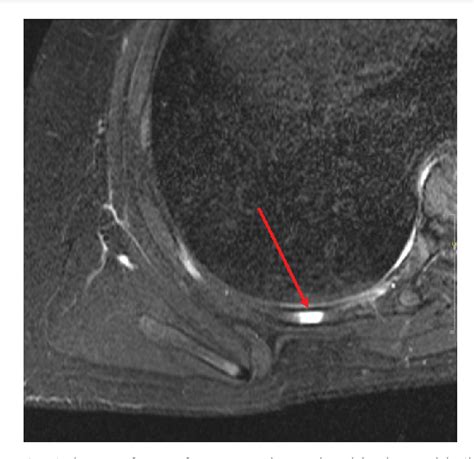 Figure From Unilateral Seventh Rib Posterior Stress Fracture In A