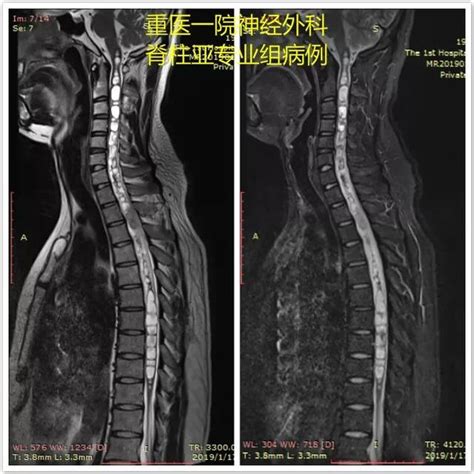 病例分享｜胸2 3髓內腫瘤一例 每日頭條