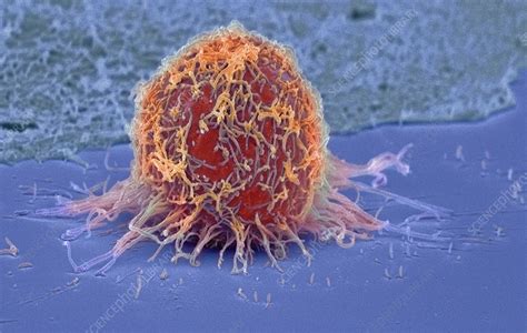 Cervical Cancer Cell SEM Stock Image M850 0445 Science Photo Library