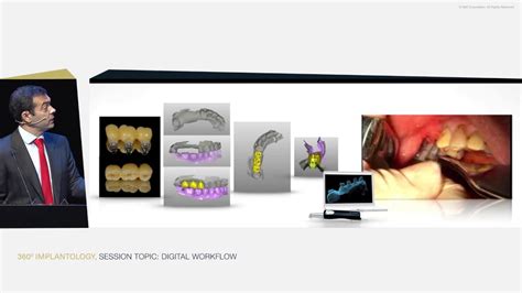 Digital Workflow In Implant Dentistry The Future Is Now Youtube