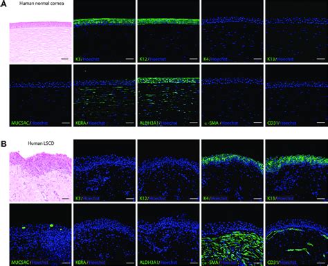 Photomicrographs Showing Normal And Pathologic Changes Of Corneal