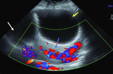 Colour Doppler On Abdominal Ultrasound Demonstrating Umbilical Cord Download Scientific Diagram