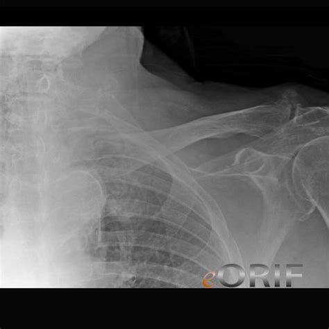 Clavicle Fracture Medial S42023a 81002 Eorif