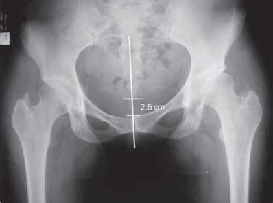 Anteroposterior Pelvic Radiograph Executed With Correct Technique