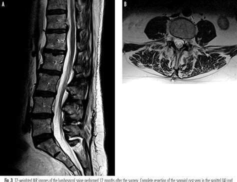 Figure 3 From Synovial Cysts Of The Lumbar Spine Semantic Scholar