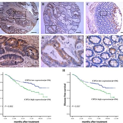 Expression Levels Of Cip2a And Survival Of Patients With Crc A D