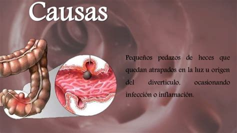 Diverticulosis