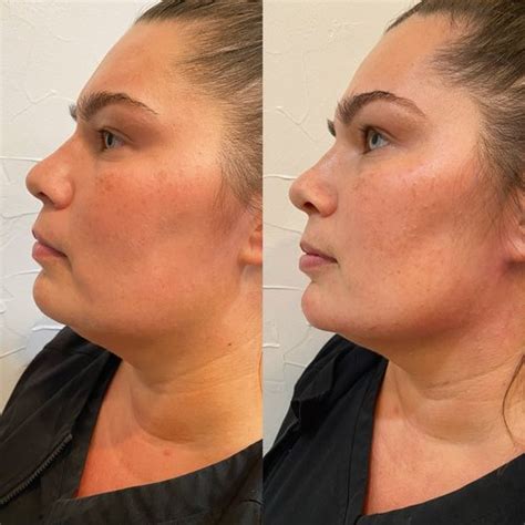 Profile Balancing And Nose Filler Brittany Wilson Np