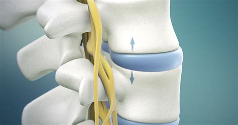 Icd 10 L5 S1 Disc Herniation With Radiculopathy