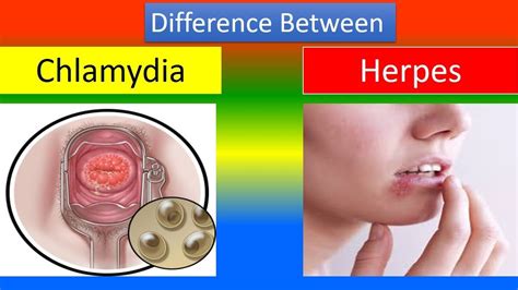 Difference Between Chlamydia And Herpes YouTube