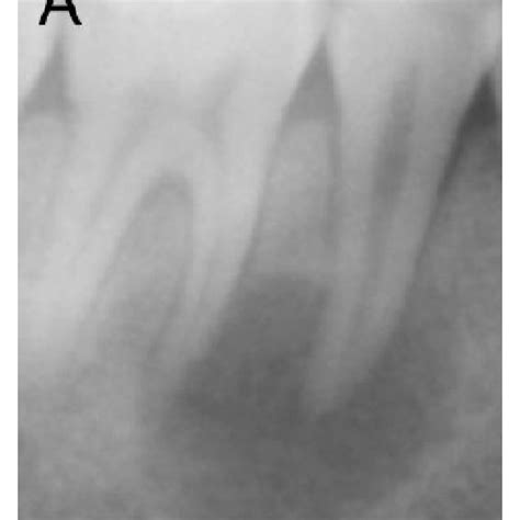 Clinical intraoral photographs. (a) Gingival swelling over the buccal ...