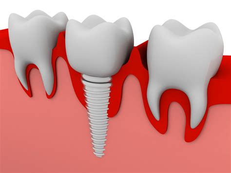 The Long-Term Advantages of Dental Implants - Balsall Common Dental