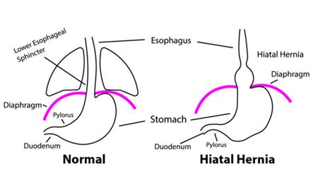 Hiatal Hernia UF Health Jacksonville