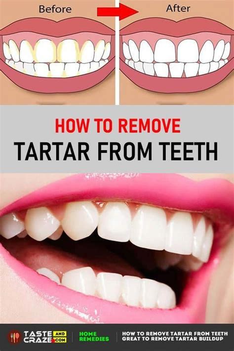 How To Remove Tartar Buildup From Teeth • Tasteandcraze In 2020