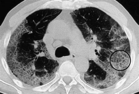 Fibrosing Lung Disease Radiology Key