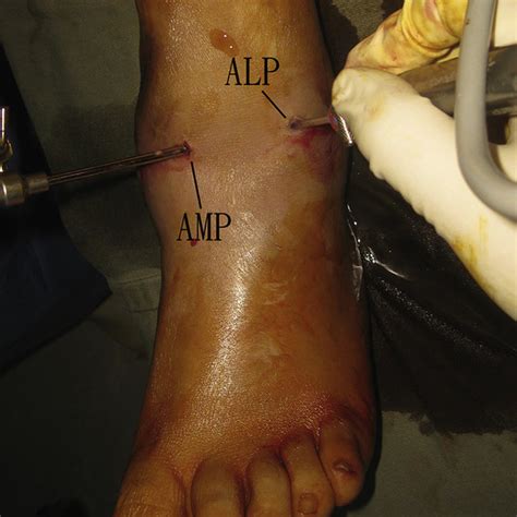 Arthroscopically Assisted Reduction Of Sagittal Plane Disruption Of