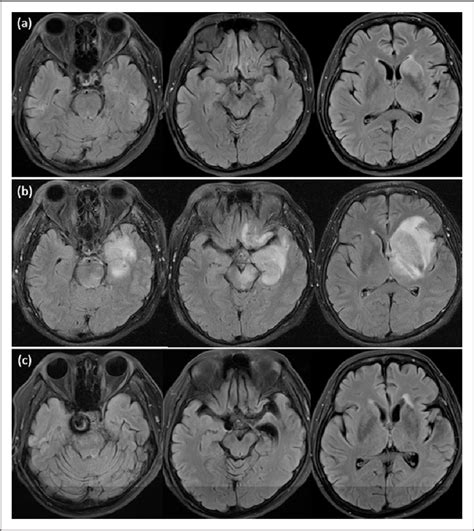 Figure 1 From Contralateral Extensive Cerebral Hemorrhagic Venous