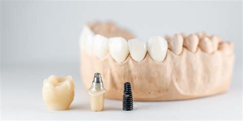 Dental Implants What Materials Are They Made Of