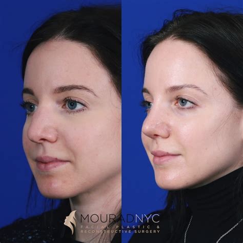 Rhinoplasty Before And After Female Facial Plastic Surgeon