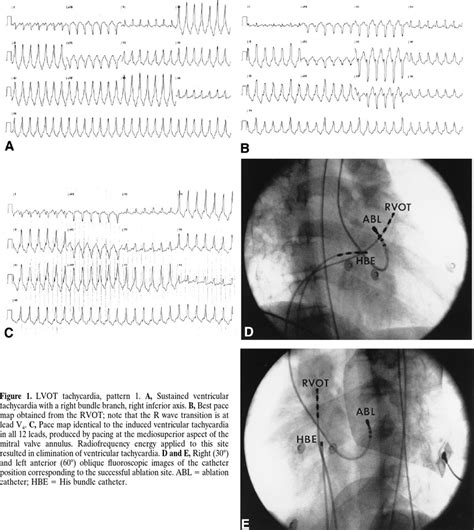 Lvot Tachycardia Pattern 1 A Sustained Ventricular Tachycardia With Download Scientific