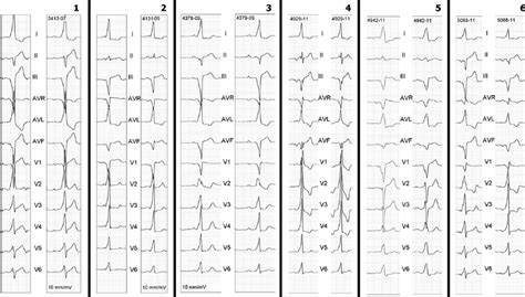 Twelve Lead ECG Showing Pre And Postablation Pattern Of Overt