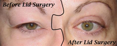 Laser Eyelid Surgery - The Eye MDs