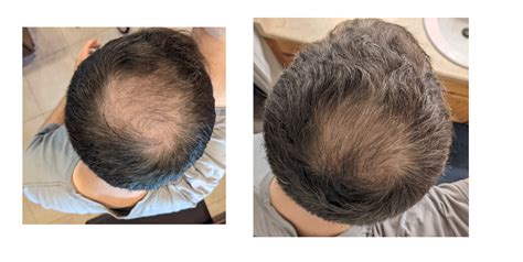 Only Minoxidil Before And After