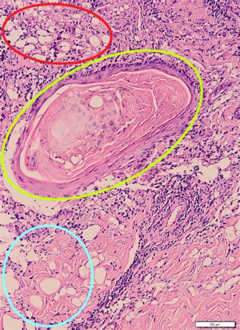 Histopathological Findings With He Staining Revealed Perivascular Red Download Scientific