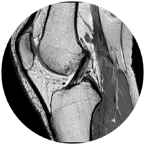 Lesão do Ligamento Cruzado Anterior Dr João Hollanda Ortopedista