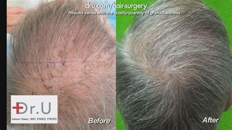 Dr Umar Hair Transplant Reviews Los Angeles 5 – Hair Restoration News ...