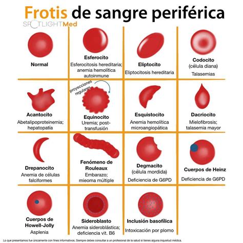 Tipos de eritrocitos en el frotis de sangre periférica SpotlightMed