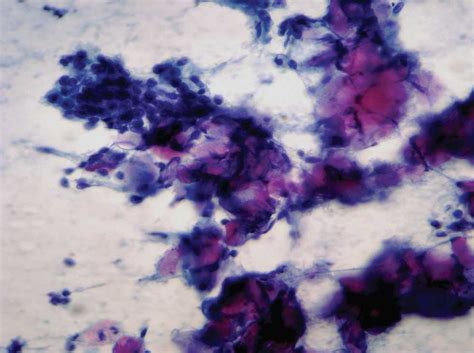 Pilomatrixoma In The Parotid Region A Case Report