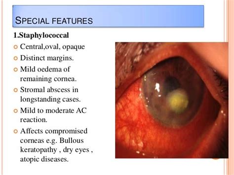 Bacterial Corneal Ulcer Drbp