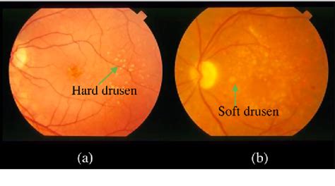 Drusen Fundus Photo