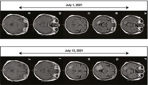 Brain Magnetic Resonance Imaging Mri Over Two Weeks Of Treatment Two