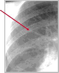 LearningRadiology - Congestive Heart Failure, CHF