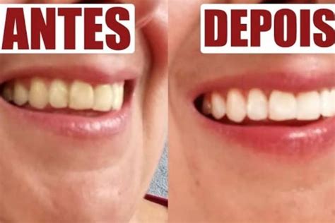 Conheça essa dica para clarear os dentes que é simplesmente sensacional