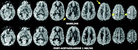 Comparative Overview Of Brain Perfusion Imaging Techniques Stroke