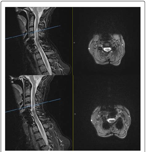 Mri Sagittal T2 Stir And Axial T2 Sequences Of The Cervical Spine Download Scientific Diagram