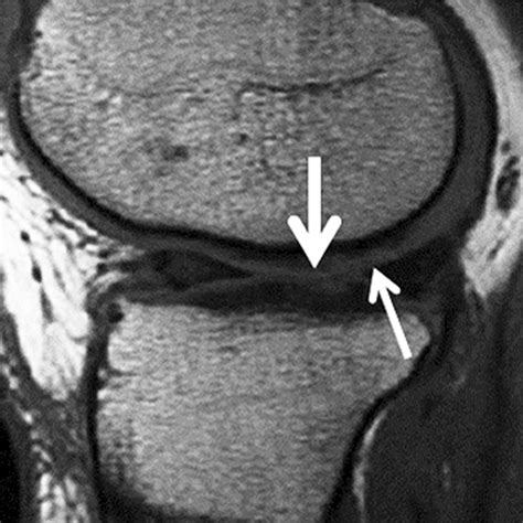 Evaluation Of The Articular Cartilage Of The Knee Joint Value Of