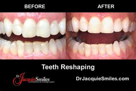 Invisalign Before And After Photos Of Nyc Patientsdr Jacquie