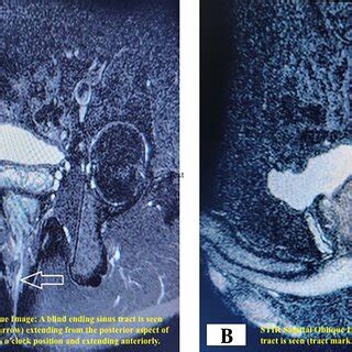 (A) STIR axial oblique image: A blind-ending sinus tract is seen (tract ...