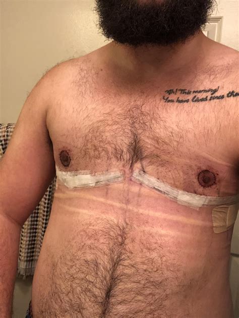 1 Week Post Op With Dr Hsu Michigan R Topsurgery