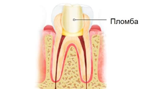 Выпала временная пломба: что делать | Стоматология "Жемчужина" | Дзен
