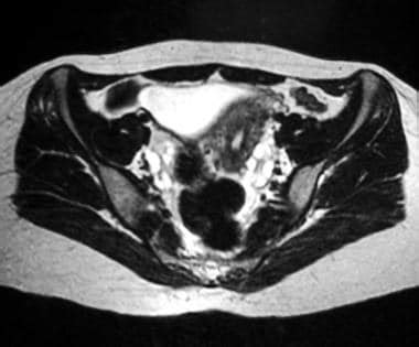 Polycystic Ovary Syndrome Pcos Imaging Practice Essentials Magnetic