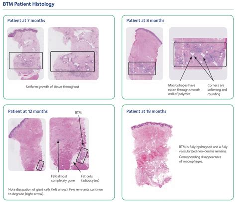 5 Frequently Asked Questions About Novosorb® Btm