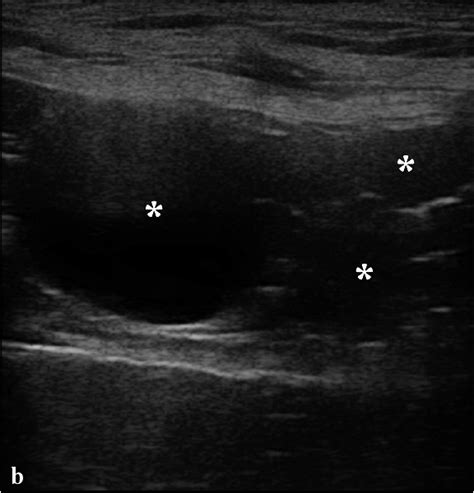 Figure From Asymptomatic Unilateral Ovarian Leiomyoma In A German