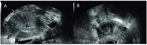 A B Mode Transvaginal Ultrasound Features Of Uterine Adenomyosis