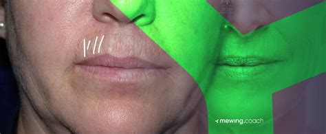 Smokers Lines How To Get Rid Of Vertical Upper Lip Wrinkles Mewing