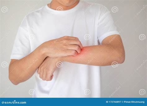 Man Itching And Scratching On Arm From Itchy Dry Skin Eczema Dermatitis